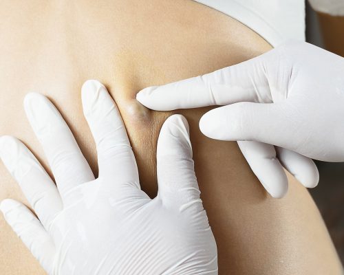 Doctor Diagnosis of the Sebaceous on Woman's Back